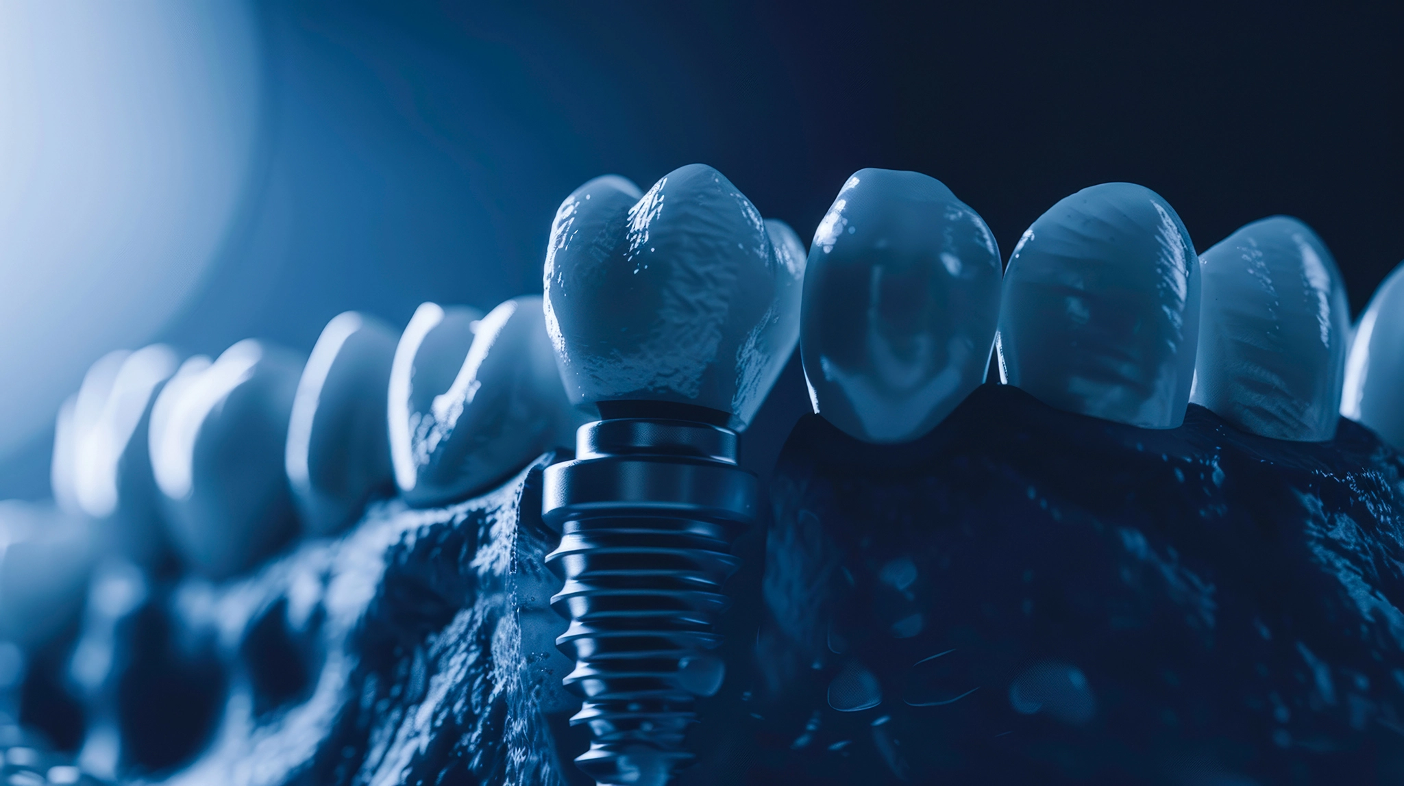 Gülüşünüzü Dönüştürün: Antalya Dental İmplantları İçin Nihai Rehber